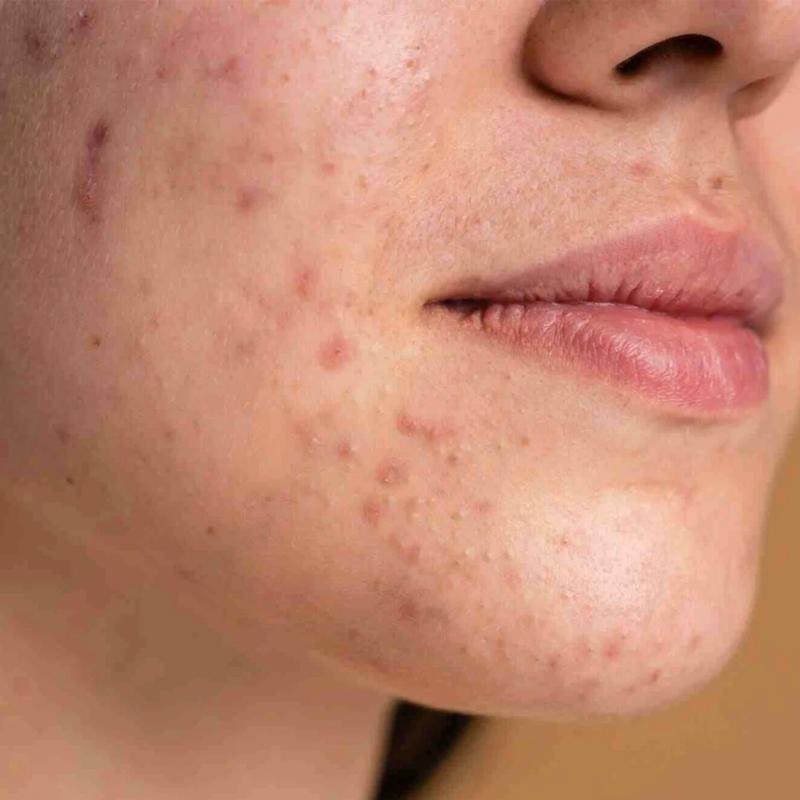 Skin Treep Perfector